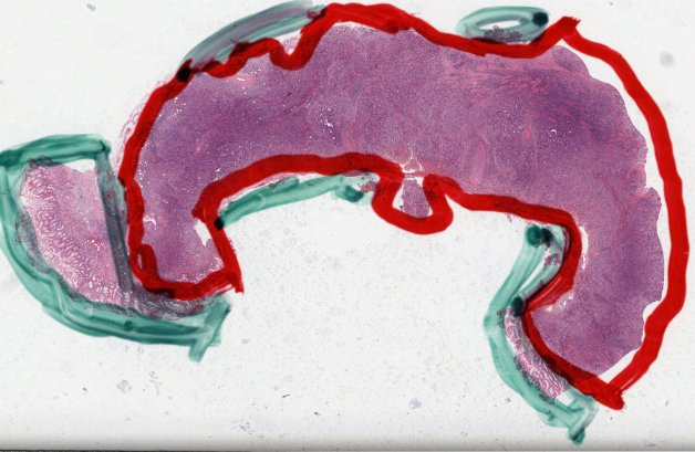 TCGA-BR-7958-01Z-00-DX1 slide with red and green pen