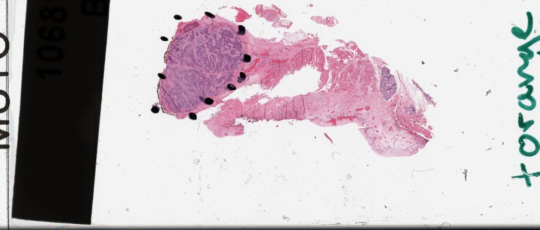 TCGA-P3-A6T6-01Z-00-DX1 slide with pen marks and ink